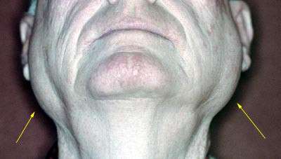 the history causes symptoms and treatment of sjogren of laarson syndrome the history causes symptoms and treatment of sjogren of laarson syndrome
